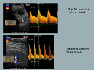 Doppler de arteria
uterina normal
Doppler de cerebral
media normal
 