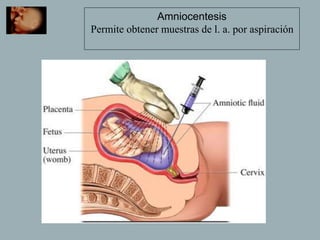 Amniocentesis
Permite obtener muestras de l. a. por aspiración
 