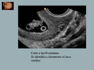 Corte a las10 semanas .
Se identifica claramente el saco
vitelino
 