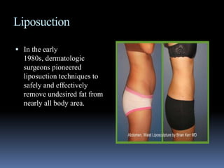 LiposuctionIn the early 1980s, dermatologic surgeons pioneered liposuction techniques to safely and effectively remove undesired fat from nearly all body area.