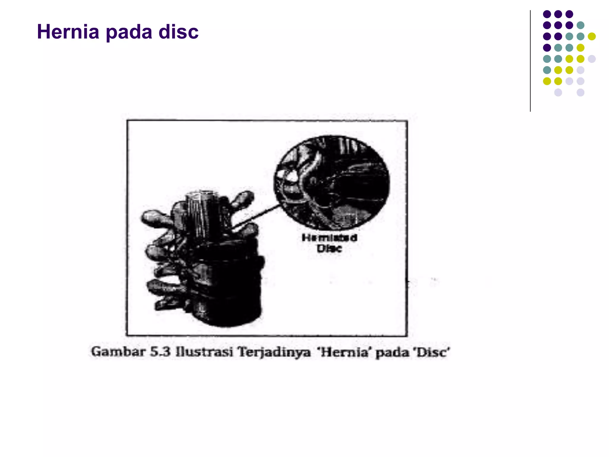 Hernia pada disc
 