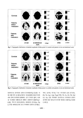 Controls 
Patients: 
before 
medication 
Patients: 
after 
medication 
at rest at attentional 
work 
w10 ? 0 05 
? v 
3 JtV ?1.00 
?10 ? 0 05 
? v 
3 JtV ?1.00 
?10 ? ?0 05 
? v 
3JA .. V ?1.00 
voltage SPM p-value 
Fig. 1. Topographic distribution of absolute amplitude of delta power in controls and patients at rest and attentional work, 
Controls 
Patients: 
before 
medication 
Patients: 
after 
medication 
at rest at attentional 
work 
? 13 ? 
? V 
3 JtV 
? 13 ? 
i v 
3 JtV 
? 1 3JtV 
? v 
3 JtV 
voltage 
?0 05 
?1.00 
?0 05 
?1.00 
?0. 05 
SPM p-value 
Fig. 2. Topographic distribution of absolute amplitude of theta power in ?onttols and patients at rest and attentional work 
????? ???? ??? ?????(p<0.05). ? 
? ?? ?? ? ?????? ????? ?? ??? 
?? ?? ???? ???? ?? ??? ?? ?? 
? ???? ????? ??? ???? ???(p) 
0.05) ?? ? ?????? ???? ??(Fp1. Fp 
2. F7? ??? 27? ??) ???? ??? ???? 
?? ??? ??? ?? ???? 15? ?? (Fz  
F4. T4, Cpl, Cp2, Tcp2 TT2, T5, Pz, P4, T6, Po2 
01, Oz, 02) ???? ????? ???? ??? 
??? ?? ???? ??? ??? ???(p<O  05) 
(?? 2) , 
? 1095 
 