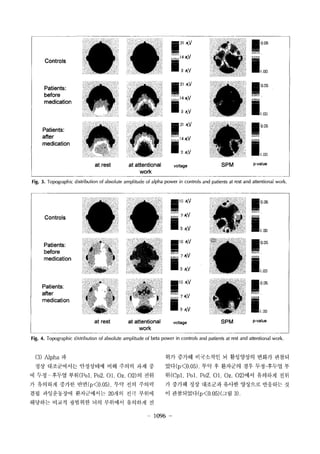 Controls 
Patients: 
before 
medication 
Patients: 
after 
medication 
at rest at aUentional 
work 
? 21 ? 
j ? 
3 JtV 
? 21 ? ? 0.05 
? v 
3 JtV 
? 21 ? ? O ? 
? v 
3 JtV 
voltage SPM p-value 
Fig. 3. Topographic distribution of absolute amplitude of alpha power in controls and patients at rest and attentional work. 
Controls 
Patients: 
before 
medication 
Patients: 
after 
medication 
at rest at aUentional 
work 
?10 JtV 
I::~ 3 JtV 
?10 JtV 
? 3 JtV 
?10 ? 
? 3 JtV 
voltage 
? 0.05 
?1.0 
? 0.05 
?1.00 
? 0.05 
?1.00 
SPM p-value 
Fig. 4. Topographic distribution of absolute amplitude of beta power in controls and patients at rest and attentional work. 
(3) Alpha ? 
?? ?????? ????? ?? ??? ?? ? 
? ?? ??? ?? (Po 1. Po2. 01. Oz. 02) ? ?? 
? ???? ??? ?? (p<0.05). ?? ?? ??? 
?? ?????? ?????? 20?? ?? ??? 
???? ??? ???? ?? ???? ???? ? 
?? ??? ????? ? ????? ??? ??? 
?? (p<0.05L ?? ? ???? ?? ??-??? ? 
? (Cpl. Pol. Po2. 01. Oz. 02) ?? ???? ?? 
? ??? ?? ???? ??? ???? ???? ? 
? ?????'(p<0.05)(?? 3). 
? 1096 
 