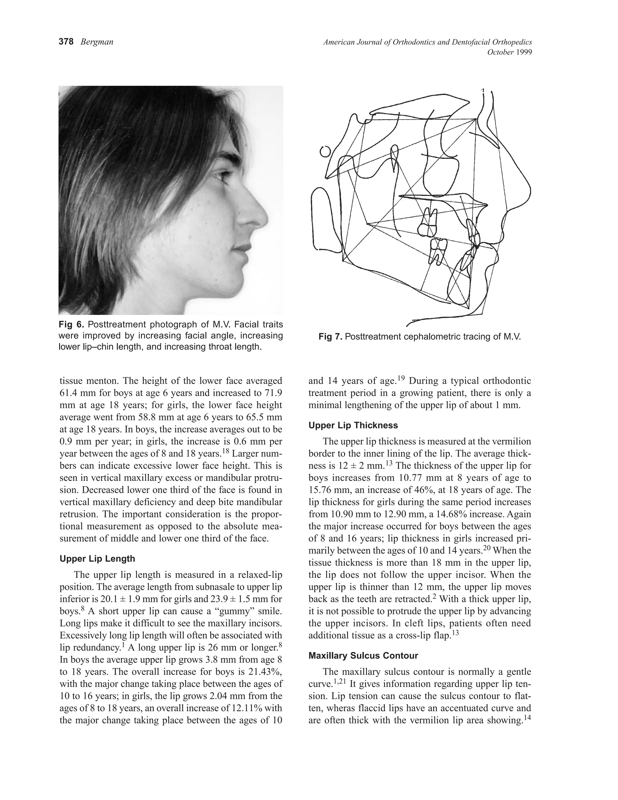 378 Bergman American Journal of Orthodontics and Dentofacial Orthopedics
October 1999
tissue menton. The height of the lower face averaged
61.4 mm for boys at age 6 years and increased to 71.9
mm at age 18 years; for girls, the lower face height
average went from 58.8 mm at age 6 years to 65.5 mm
at age 18 years. In boys, the increase averages out to be
0.9 mm per year; in girls, the increase is 0.6 mm per
year between the ages of 8 and 18 years.18 Larger num-
bers can indicate excessive lower face height. This is
seen in vertical maxillary excess or mandibular protru-
sion. Decreased lower one third of the face is found in
vertical maxillary deficiency and deep bite mandibular
retrusion. The important consideration is the propor-
tional measurement as opposed to the absolute mea-
surement of middle and lower one third of the face.
Upper Lip Length
The upper lip length is measured in a relaxed-lip
position. The average length from subnasale to upper lip
inferior is 20.1 ± 1.9 mm for girls and 23.9 ± 1.5 mm for
boys.8 A short upper lip can cause a “gummy” smile.
Long lips make it difficult to see the maxillary incisors.
Excessively long lip length will often be associated with
lip redundancy.1 A long upper lip is 26 mm or longer.8
In boys the average upper lip grows 3.8 mm from age 8
to 18 years. The overall increase for boys is 21.43%,
with the major change taking place between the ages of
10 to 16 years; in girls, the lip grows 2.04 mm from the
ages of 8 to 18 years, an overall increase of 12.11% with
the major change taking place between the ages of 10
and 14 years of age.19 During a typical orthodontic
treatment period in a growing patient, there is only a
minimal lengthening of the upper lip of about 1 mm.
Upper Lip Thickness
The upper lip thickness is measured at the vermilion
border to the inner lining of the lip. The average thick-
ness is 12 ± 2 mm.13 The thickness of the upper lip for
boys increases from 10.77 mm at 8 years of age to
15.76 mm, an increase of 46%, at 18 years of age. The
lip thickness for girls during the same period increases
from 10.90 mm to 12.90 mm, a 14.68% increase. Again
the major increase occurred for boys between the ages
of 8 and 16 years; lip thickness in girls increased pri-
marily between the ages of 10 and 14 years.20 When the
tissue thickness is more than 18 mm in the upper lip,
the lip does not follow the upper incisor. When the
upper lip is thinner than 12 mm, the upper lip moves
back as the teeth are retracted.2 With a thick upper lip,
it is not possible to protrude the upper lip by advancing
the upper incisors. In cleft lips, patients often need
additional tissue as a cross-lip flap.13
Maxillary Sulcus Contour
The maxillary sulcus contour is normally a gentle
curve.1,21 It gives information regarding upper lip ten-
sion. Lip tension can cause the sulcus contour to flat-
ten, wheras flaccid lips have an accentuated curve and
are often thick with the vermilion lip area showing.14
Fig 6. Posttreatment photograph of M.V. Facial traits
were improved by increasing facial angle, increasing
lower lip–chin length, and increasing throat length.
Fig 7. Posttreatment cephalometric tracing of M.V.
 