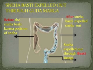 After sneha
basti ;expelled
sneha out
Before the
sneha basti
karma position
of sneha
Sneha
expelled out
through Basti
marga
 