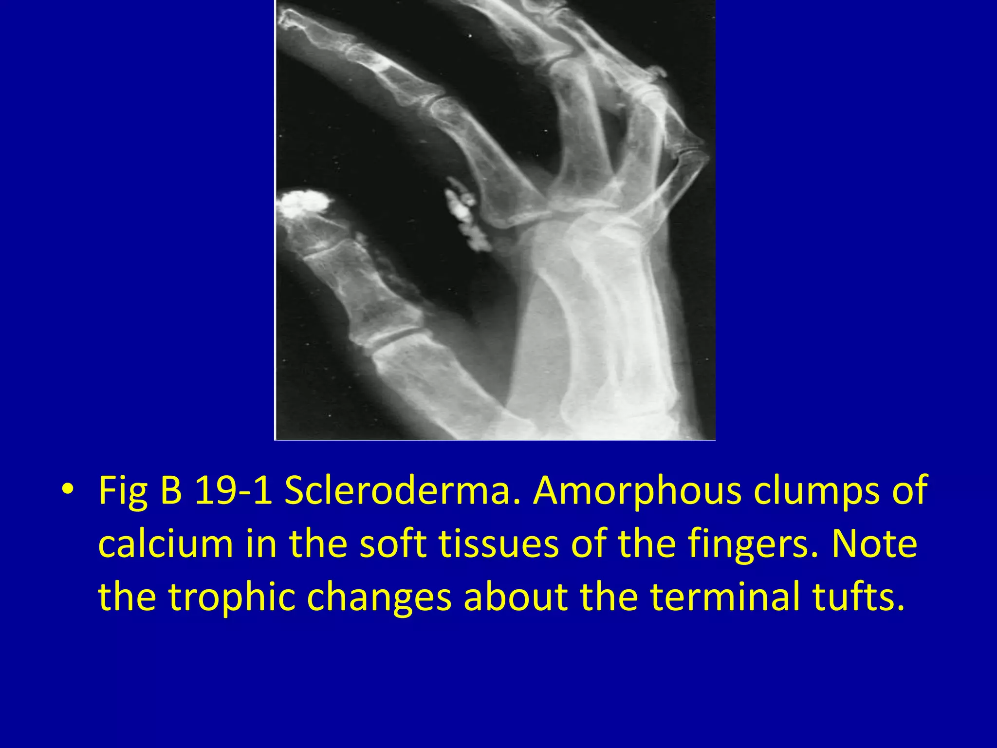 19 calcification about the fingertips | PPT