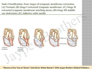 Sade Classification 19 chronic suppurative otitis media and cholesteatoma.pptx