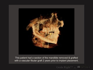This patient had a section of the mandible removed & grafted
with a vascular fibular graft 2 years prior to implant placem...