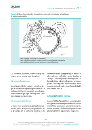 Protocolos • Glomerulonefritis aguda postinfecciosa
307
©Asociación Española de Pediatría. Prohibida la reproducción de los contenidos sin la autorización correspondiente.
Protocolos actualizados al año 2014. Consulte condiciones de uso y posibles nuevas actualizaciones en www.aeped.es/protocolos/
ISSN 2171-8172
Las anomalías tubulares, intersticiales y vas-
culares son en general poco llamativas.
5.2. Inmunofluorescencia
Sobre la pared de los capilares y en el mesan-
gio se encuentran depósitos granulares de C3
junto con IgG (humps o jorobas), también pue-
de encontrarse IgM, IgA, fibrina y otros com-
ponentes del complemento.
5.3. Microscopia electrónica
La lesión más característica de la glomerulo-
nefritis aguda, aunque no patognomónica, es
la presencia en la vertiente externa de la
membrana basal (subepitelial) de depósitos
electrodensos referidos como jorobas o
“humps”. También puede haber depósitos su-
bendoteliales, intramembranosos y mesan-
giales. Estos depósitos son complejos inmu-
nes y corresponden a los depósitos de IgG y C3
visualizados en la IF.
6. MANIFESTACIONES CLÍNICAS
Aunque la GNAPI puede tener un curso subclí-
nico, generalmente se presenta como síndro-
me nefrítico agudo, más raramente como sín-
drome nefrótico y de forma excepcional como
glomerulonefritis rápidamente progresiva.
Figura 1. El daño glomerular y los signos clínicos están determinados por la localización
de los inmunocomplejos
Daño mesangial: proteinuria y microhematuria.
Daño endocapilar: proteinuria, hematuria, insuficiencia renal, lesiones inflamatorias.
Daño epitelial: proteinuria en rango nefrótico, no lesiones inflamatorias.
Daño mesangial
Daño endocapilar
Daño epitelial
 