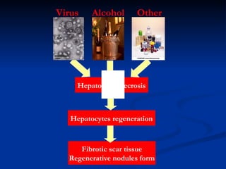 Hepatocytes necrosis Hepatocytes  regenerati on F ibrotic scar tissue R egenerative nodules  form Virus Alcohol Other 