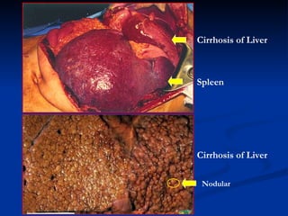 Cirrhosis of Liver Spleen Cirrhosis of Liver N odular 