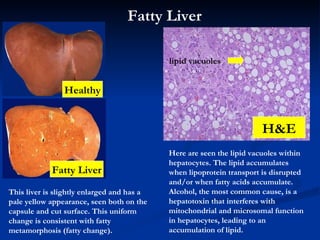 This liver is slightly enlarged and has a pale yellow appearance, seen both on the capsule and cut surface. This uniform change is consistent with fatty metamorphosis (fatty change). Here are seen the lipid vacuoles within hepatocytes. The lipid accumulates when lipoprotein transport is disrupted and/or when fatty acids accumulate. Alcohol, the most common cause, is a hepatotoxin that interferes with mitochondrial and microsomal function in hepatocytes, leading to an accumulation of lipid. Fatty Liver H&E Fatty Liver lipid vacuoles Healthy 