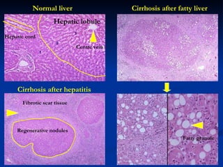 Normal liver Cirrhosis after hepatitis Cirrhosis after fatty liver R egenerative nodules F ibrotic scar tissue Hepatic  lobule   Centre vein Fatty  granule H epatic cord  