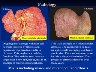 Ongoing liver damage with liver cell necrosis followed by fibrosis and hepatocyte regeneration results in cirrhosis. This produces a nodular, firm liver. The nodules seen here are larger than 3 mm and, hence, this is an example of macronodular cirrhosis.  This is an example of a micronodular cirrhosis. The regenerative nodules are quite small, averaging less than 3 mm in size. The most common cause for this is chronic alcoholism. The process of cirrhosis develops over many years.  M acronodular cirrhosis M icronodular cirrhosis >3.0mm <3.0mm Mix is including maro- and micronodular cirrhosis  Pathology  