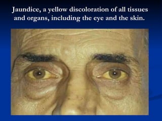 J aundice ,  a yellow discoloration of all tissues and organs, including  the eye and  the skin.  