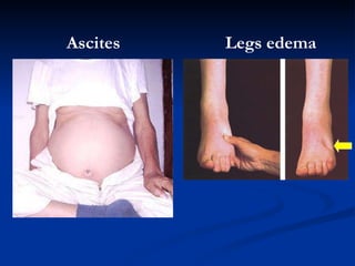 A scites L egs edema 