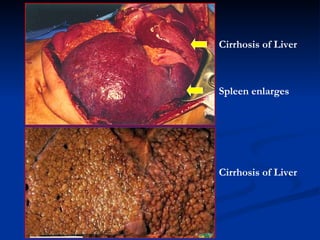 Cirrhosis of Liver Spleen  enlarges Cirrhosis of Liver 