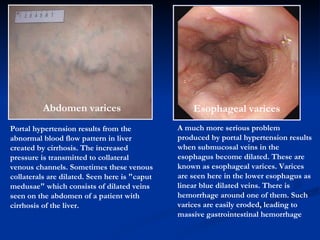 Portal hypertension results from the abnormal blood flow pattern in liver created by cirrhosis. The increased pressure is transmitted to collateral venous channels. Sometimes these venous collaterals are dilated. Seen here is "caput medusae" which consists of dilated veins seen on the abdomen of a patient with cirrhosis of the liver.  A bdomen varices Esophageal   varices A much more serious problem produced by portal hypertension results when submucosal veins in the esophagus become dilated. These are known as esophageal varices. Varices are seen here in the lower esophagus as linear blue dilated veins. There is hemorrhage around one of them. Such varices are easily eroded, leading to massive gastrointestinal hemorrhage 