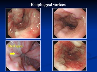 Esophageal   varices Red spot 