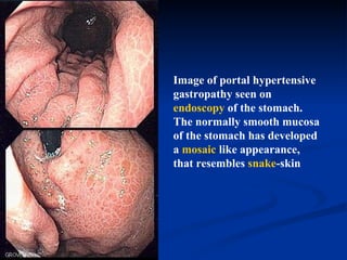 Image of portal hypertensive gastropathy seen on  endoscopy  of the stomach. The normally smooth mucosa of the stomach has developed a  mosaic  like appearance, that resembles  snake -skin  