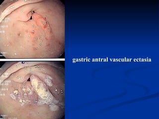 gastric antral vascular ectasia 