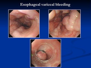Esophageal   varice al bleeding 