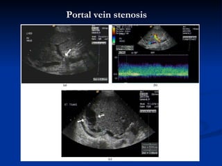 P ortal vein   stenosis   