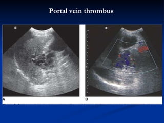 P ortal vein  thrombus 