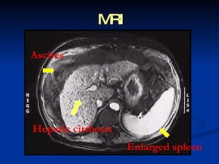 MRI A scites Hepatic cirrhosis Enlarged spleen 