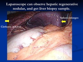 Laparoscope can observe hepatic  regenerative nodular , and get liver biopsy sample.   Cirrhosis of Liver Spleen  enlarges 