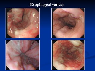 Esophageal   varices 