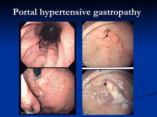 Portal hypertensive gastropathy   