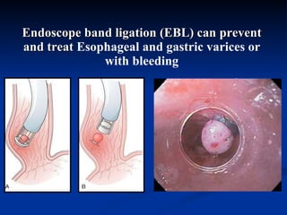 E ndoscope band ligation  ( EBL ) can prevent and treat  Esophageal  and gastric  varices  or with bleeding 