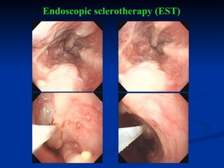 Endoscopic sclerotherapy (EST) 
