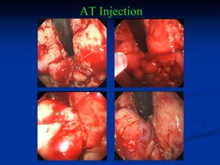 AT Injection 