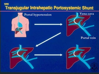 P ortal hypertension Portal vein V ena cava 