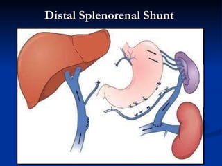 Distal Splenorenal Shunt 