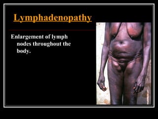 Lymphadenopathy
Enlargement of lymph
nodes throughout the
body.
 