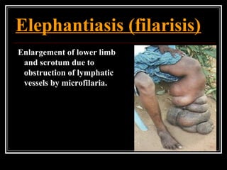 Elephantiasis (filarisis)
Enlargement of lower limb
and scrotum due to
obstruction of lymphatic
vessels by microfilaria.
 