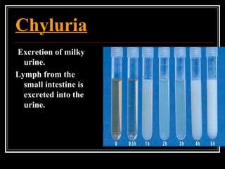Chyluria
Excretion of milky
urine.
Lymph from the
small intestine is
excreted into the
urine.
 