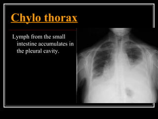 Chylo thorax
Lymph from the small
intestine accumulates in
the pleural cavity.
 