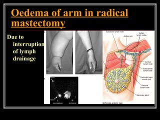 Oedema of arm in radical
mastectomy
Due to
interruption
of lymph
drainage
 