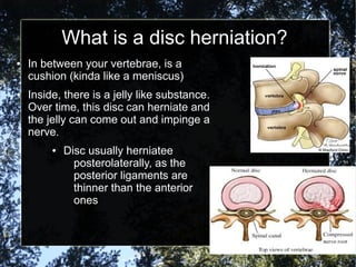 What is a disc herniation?
● In between your vertebrae, is a
cushion (kinda like a meniscus)
● Inside, there is a jelly like substance.
Over time, this disc can herniate and
the jelly can come out and impinge a
nerve.
● Disc usually herniatee
posterolaterally, as the
posterior ligaments are
thinner than the anterior
ones
 