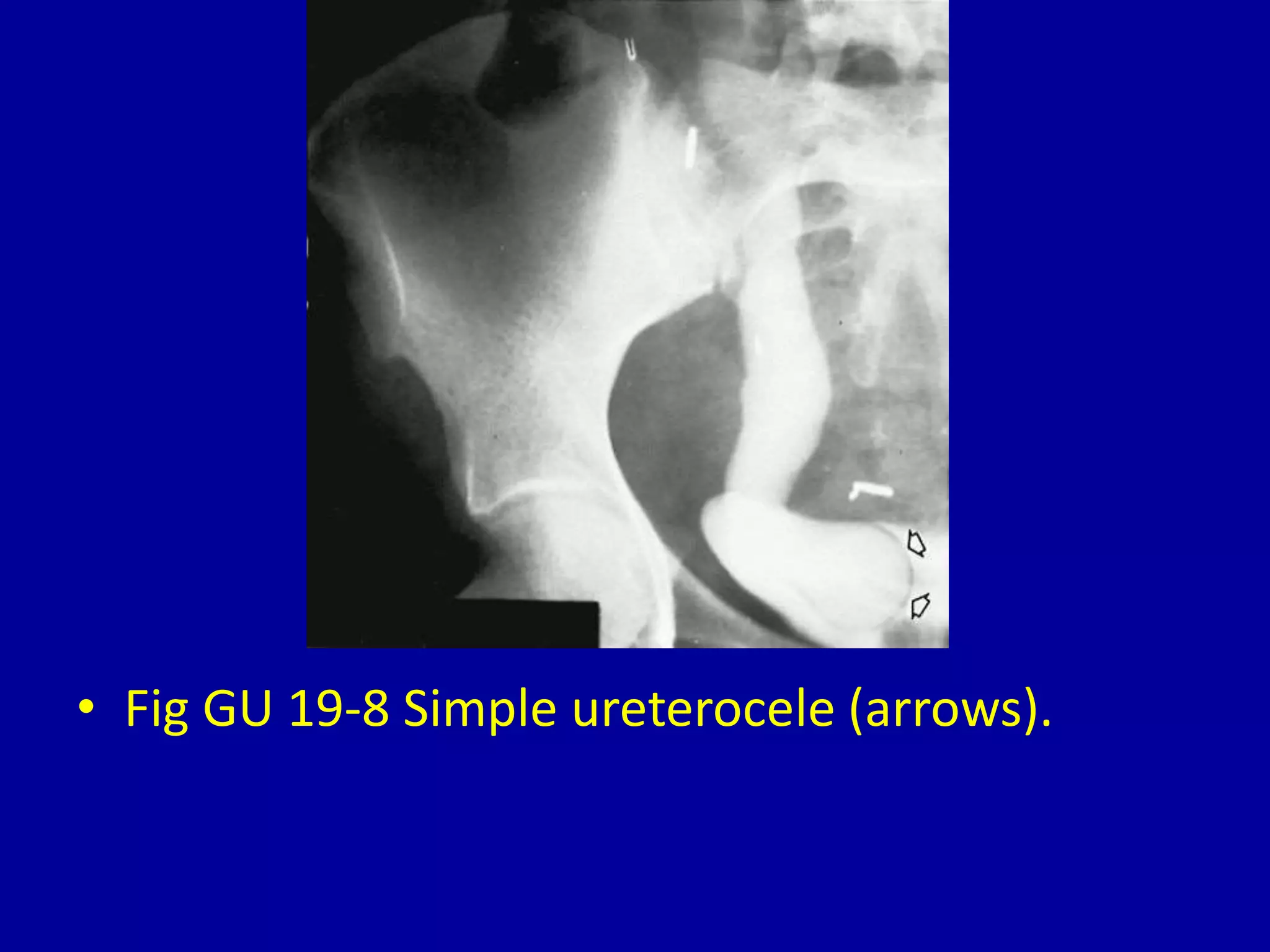 • Fig GU 19-8 Simple ureterocele (arrows).
 