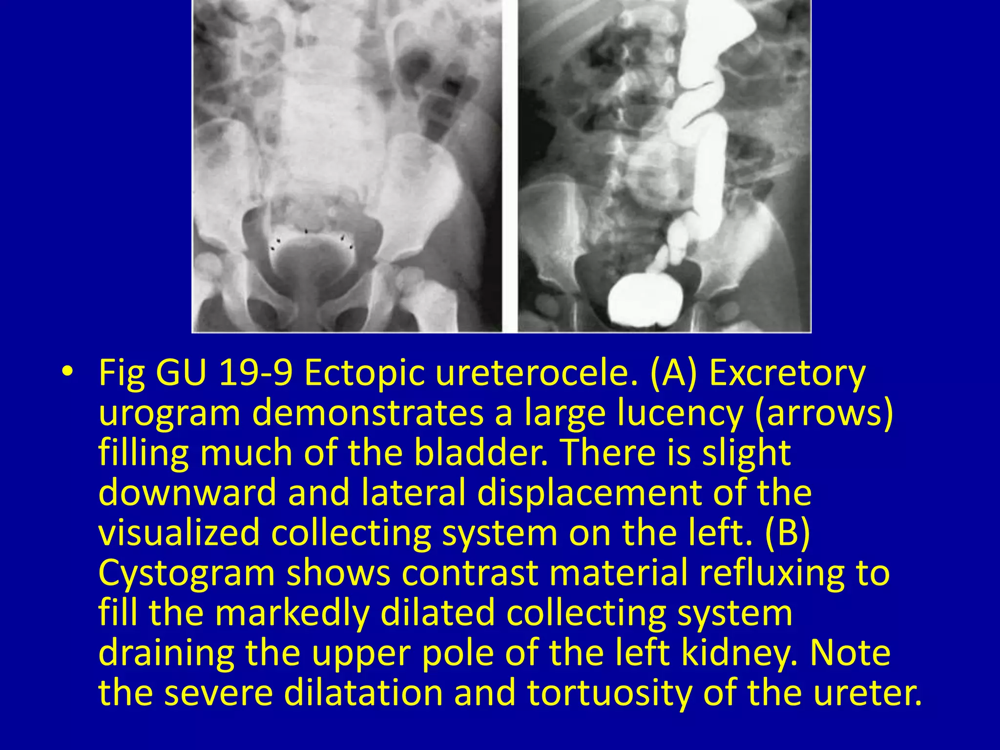 • Fig GU 19-9 Ectopic ureterocele. (A) Excretory
urogram demonstrates a large lucency (arrows)
filling much of the bladder. There is slight
downward and lateral displacement of the
visualized collecting system on the left. (B)
Cystogram shows contrast material refluxing to
fill the markedly dilated collecting system
draining the upper pole of the left kidney. Note
the severe dilatation and tortuosity of the ureter.
 