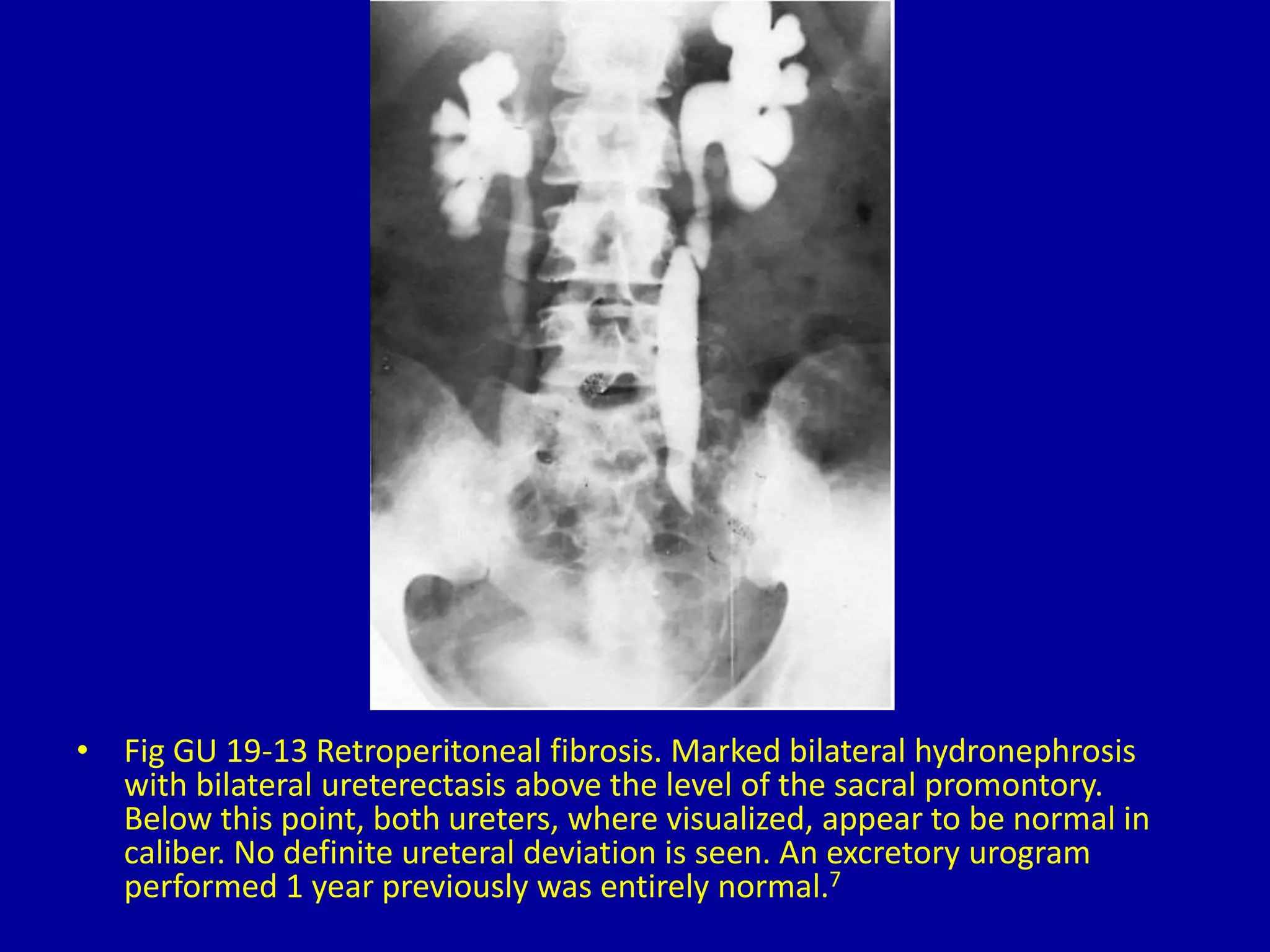 • Fig GU 19-13 Retroperitoneal fibrosis. Marked bilateral hydronephrosis
with bilateral ureterectasis above the level of the sacral promontory.
Below this point, both ureters, where visualized, appear to be normal in
caliber. No definite ureteral deviation is seen. An excretory urogram
performed 1 year previously was entirely normal.7
 