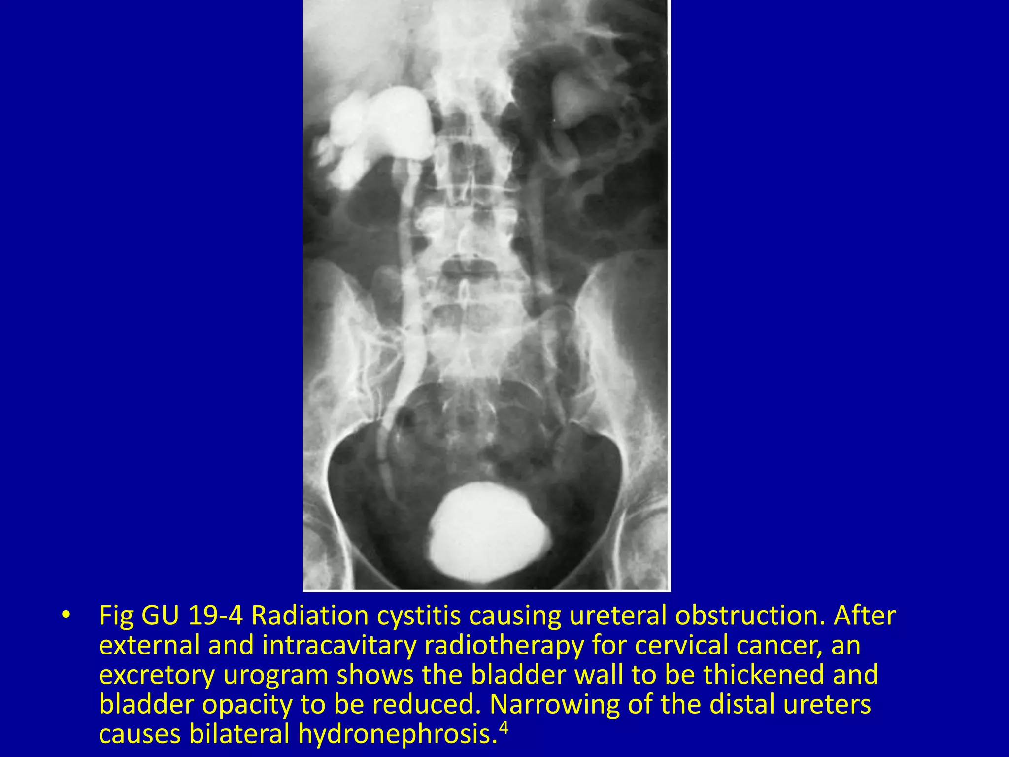 • Fig GU 19-4 Radiation cystitis causing ureteral obstruction. After
external and intracavitary radiotherapy for cervical cancer, an
excretory urogram shows the bladder wall to be thickened and
bladder opacity to be reduced. Narrowing of the distal ureters
causes bilateral hydronephrosis.4
 