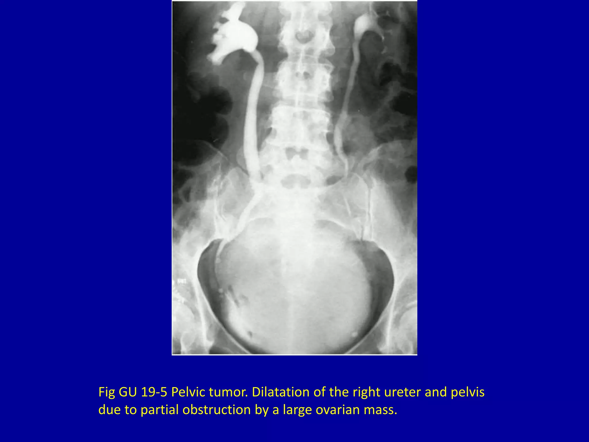 Fig GU 19-5 Pelvic tumor. Dilatation of the right ureter and pelvis
due to partial obstruction by a large ovarian mass.
 