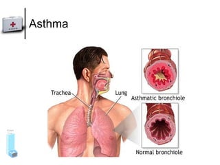 Asthma 