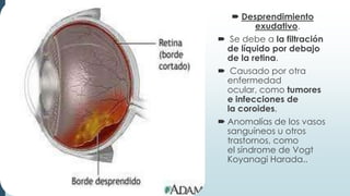  Desprendimiento
exudativo.
 Se debe a la filtración
de líquido por debajo
de la retina.
 Causado por otra
enfermedad
ocular, como tumores
e infecciones de
la coroides,
 Anomalías de los vasos
sanguíneos u otros
trastornos, como
el síndrome de Vogt
Koyanagi Harada..

 